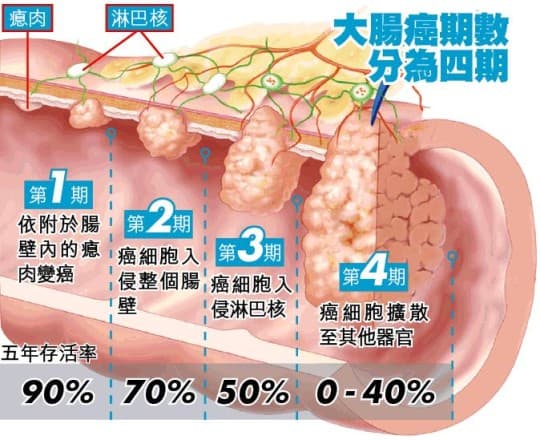 大腸癌1