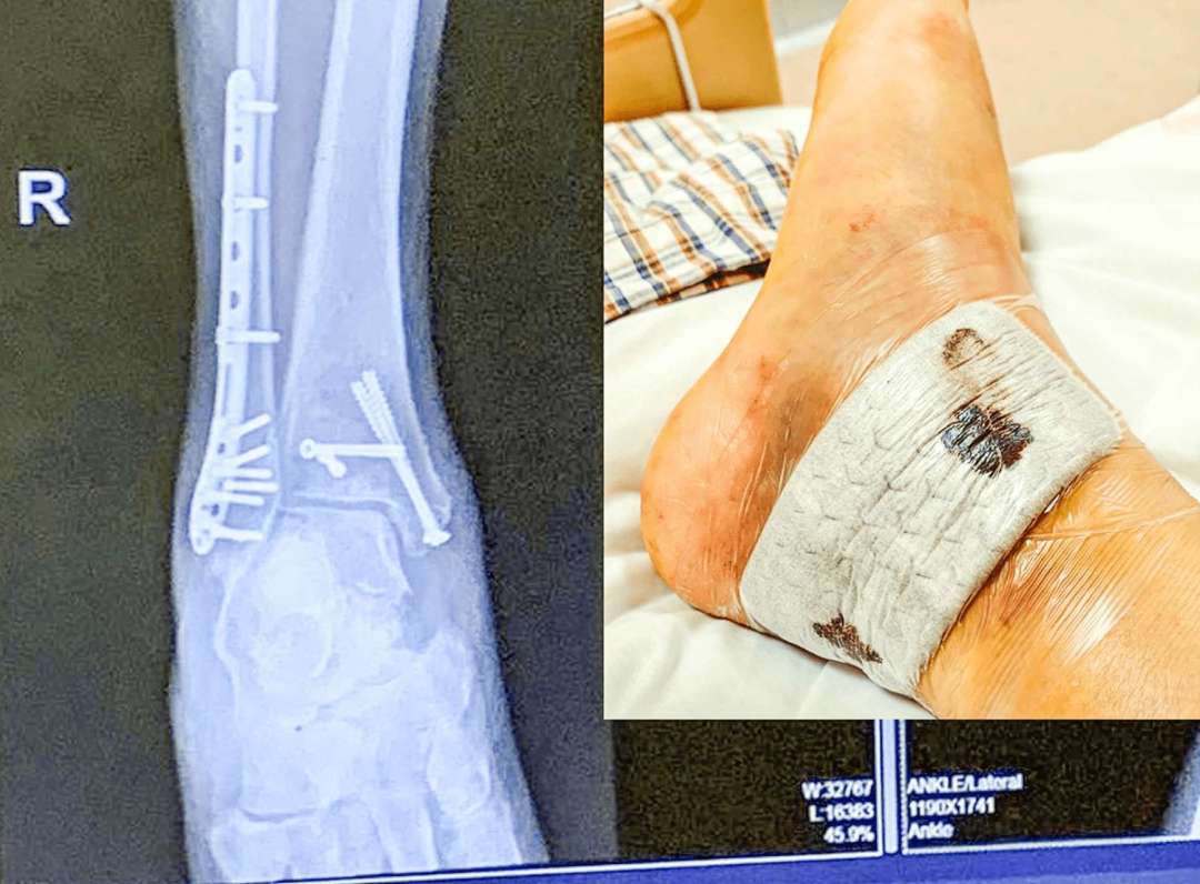 阿萱右腳髁嚴重骨折，要用13顆鋼釘和鋼板固定。相片由受訪者提供